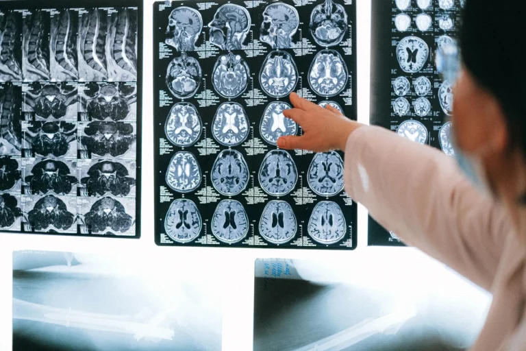 Does Epilepsy Cause Memory Loss? Complete Guide